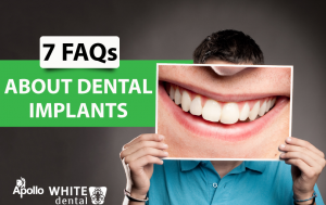 FAQs On Dental Implants!